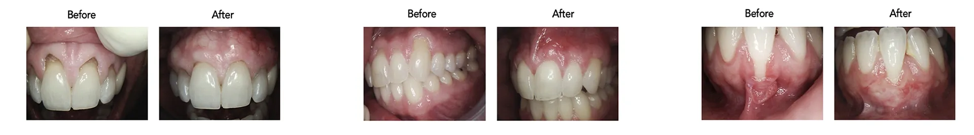 Before and after photos showing gum recession and soft tissue grafting results
