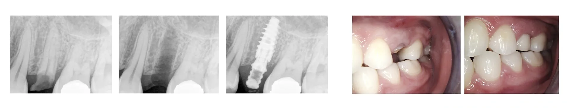 Dental implant procedure — before, during, and after X-rays and clinical photos